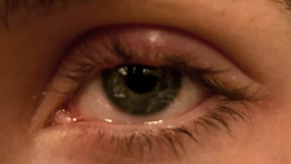 Halacion (chalazion)